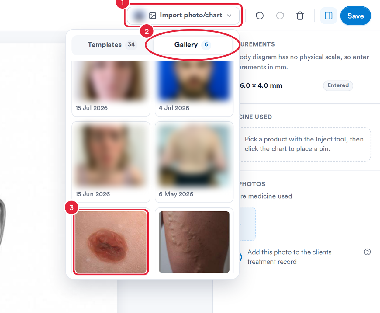 The Import photo/chart menu open on the Gallery tab with a mole photo marked