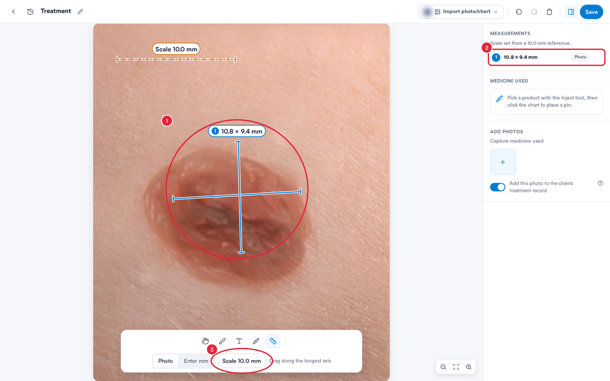 Length and width lines across a mole on the photo, the Photo measurement in the list and the Scale button marked